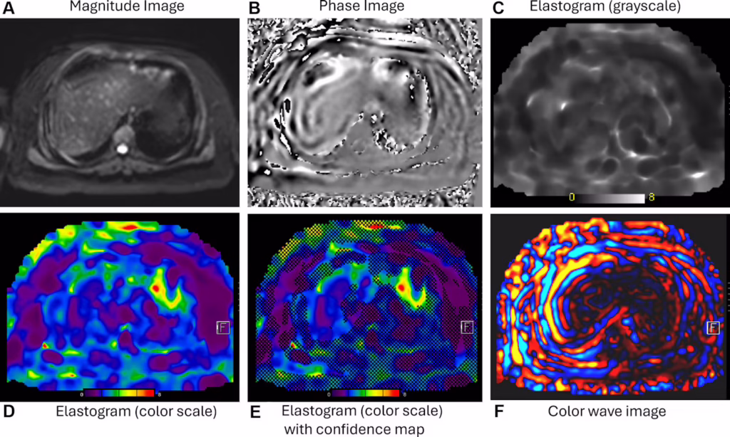 MR elastography study in a 17-year old male patient.